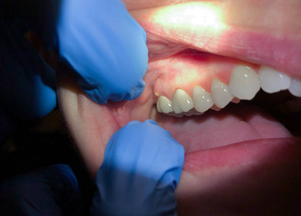 Best Emergency Treatment for Dental Infections or Abscesses in Pleasant Hills, PA